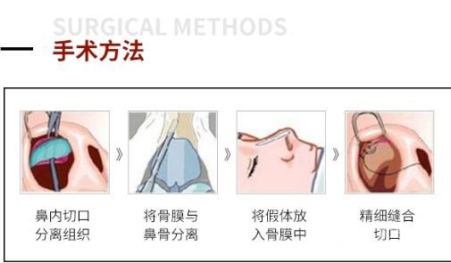 假体隆鼻手术的材料