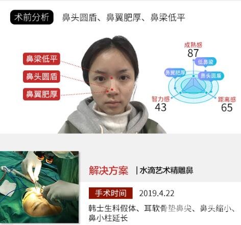 膨体假体的隆鼻