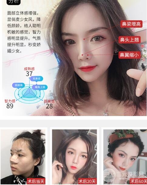 假体隆鼻手术的建议