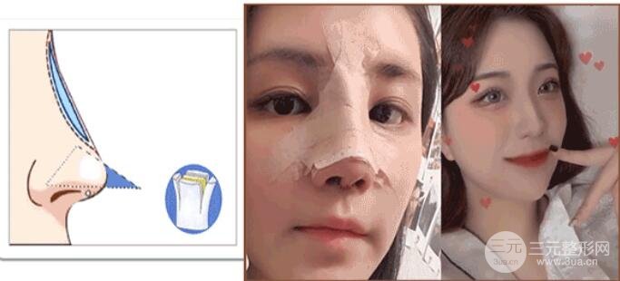 韩国的假体隆鼻技术咋样?