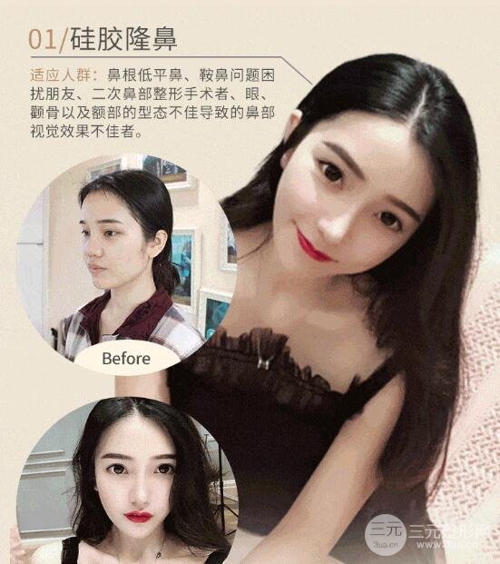 硅胶隆鼻手术价格和医院有关