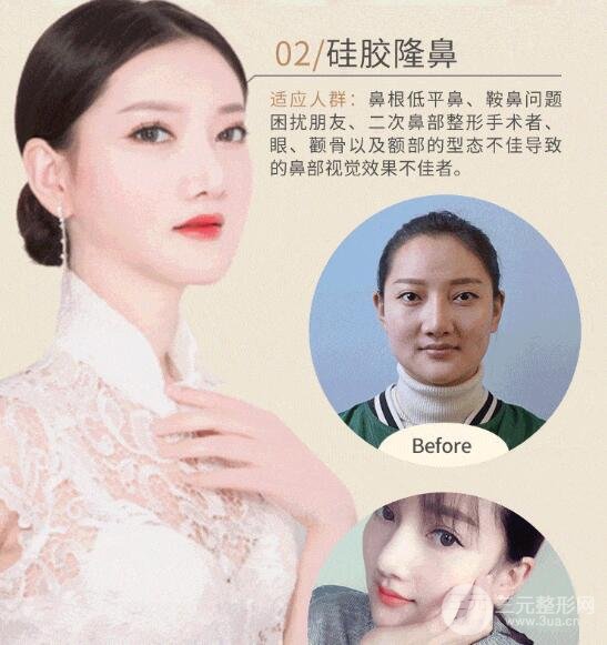 硅胶隆鼻手术价格和医生有关