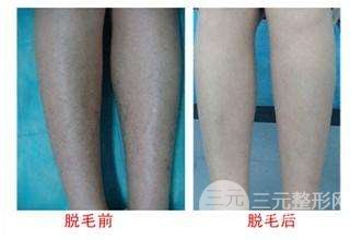 小腿激光脱毛价格多少钱？什么因素影响价格？