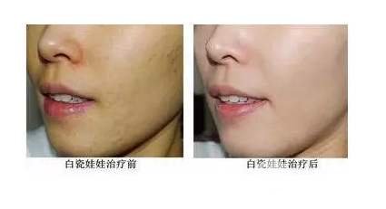 白瓷娃娃美容多少钱? 原来受这些因素影响~