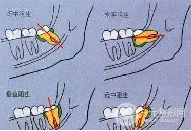 广东省口腔医院拔牙多少钱