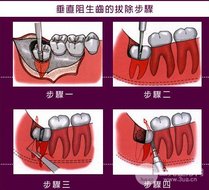 华西口腔医院拔牙多少钱