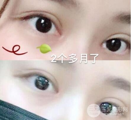 武汉中南医院美容科技术怎样 双眼皮案例图