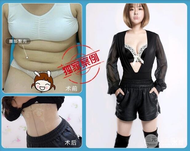 吸脂塑型果图
