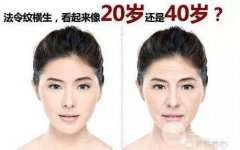 热玛吉除皱果怎么样?解决衰老问题小case! 热玛吉除皱果怎么样?解决衰老问题小case!