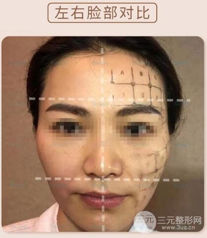 热玛吉除皱果对比图