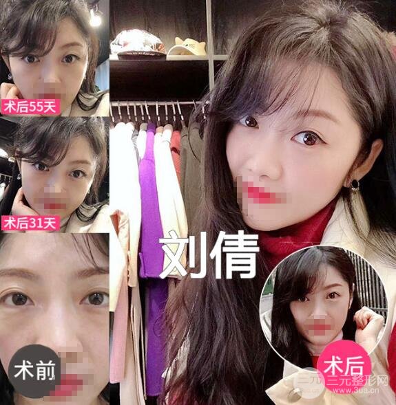 天生眼袋怎么消除?去眼袋果图