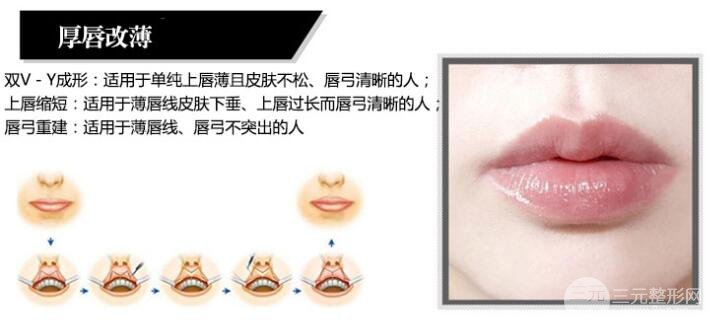 厚唇改薄项目