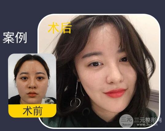 去颊脂垫手术果