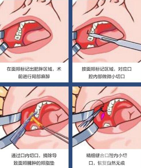 去颊脂垫手术如何操作?