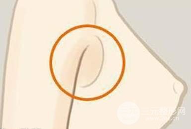 副乳吸脂有风险吗 轻松赶走“尴尬“赘肉!