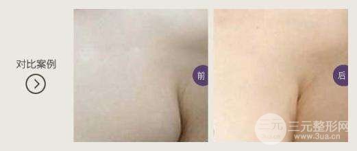 副乳吸脂有风险吗 轻松赶走“尴尬“赘肉!