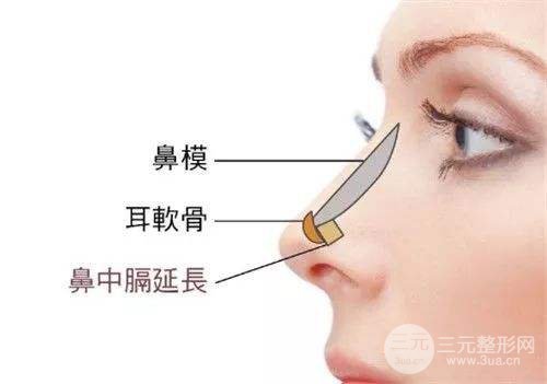 鼻部综合整形价格多少钱 主要受3点因素影响~