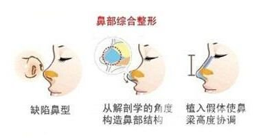 鼻部综合整形价格多少钱 主要受3点因素影响~