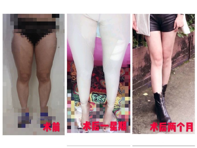 怎么样溶脂吸脂?手术操作步骤及原理