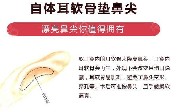 自软骨隆鼻术后可以侧睡吗