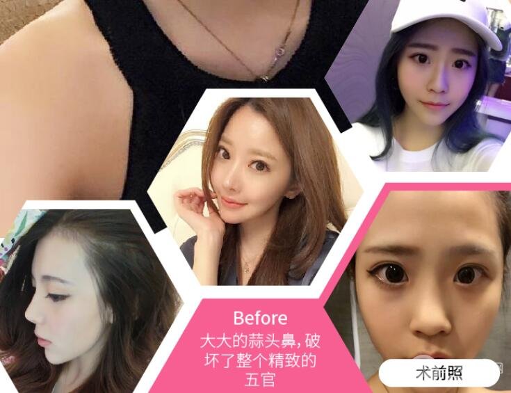 注射隆鼻的方式