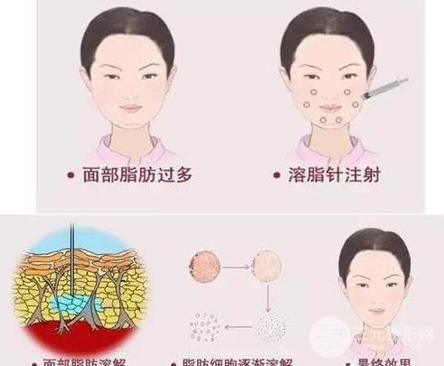 “懒人神器”——注射溶脂瘦脸价格亲民!