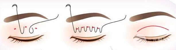 双眼皮埋线价格多少钱？受到这几个因素影响！