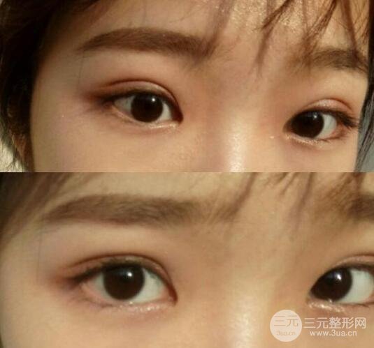 微创双眼皮是怎么做的?能维持多久?