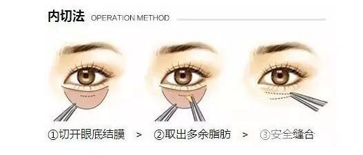 内切祛眼袋后遗症有哪些?几天消肿?