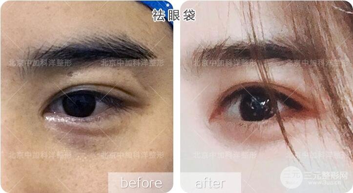 内切祛眼袋果图