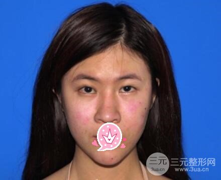 交大二附院激光美容科双眼皮案例