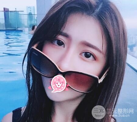 交大二附院激光美容科双眼皮案例