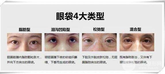 眼袋类型