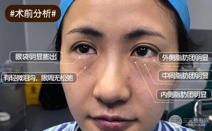 眼袋的类型和去除方式