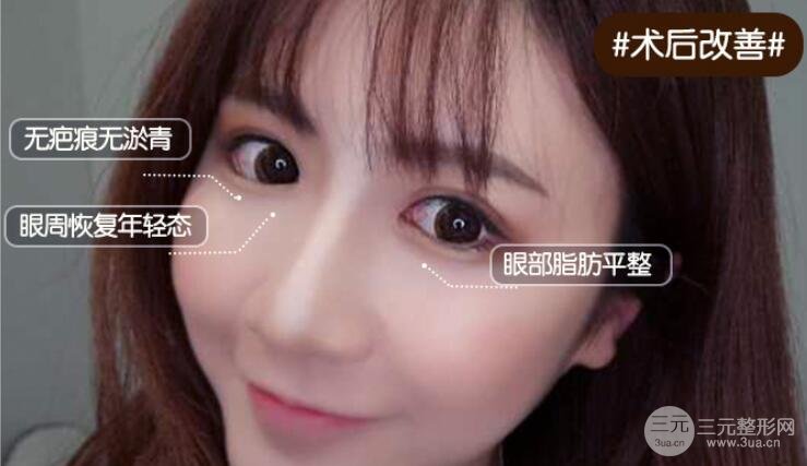 眼袋的类型和去除方式