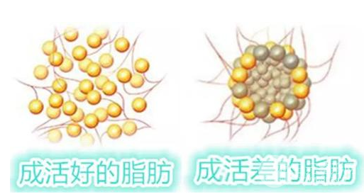 自体脂肪填充太阳穴