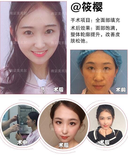 自体脂肪填充太阳穴