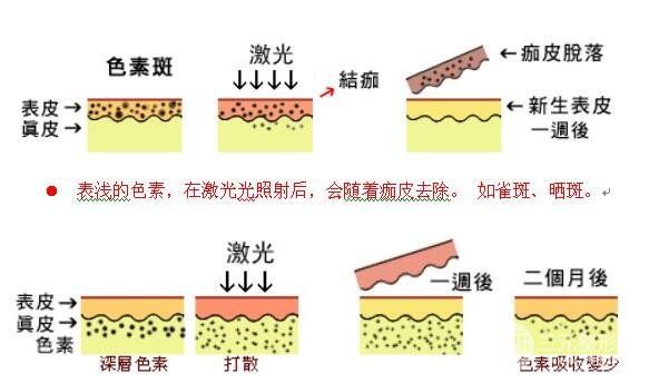 激光的使用
