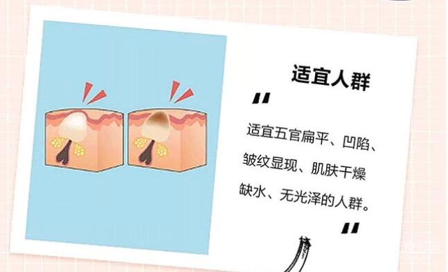 玻尿酸填充鼻唇沟