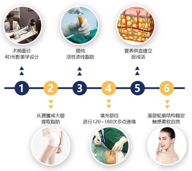 自体脂肪填充鼻唇沟