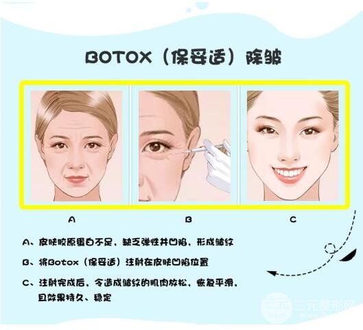 ****注射除皱原理图