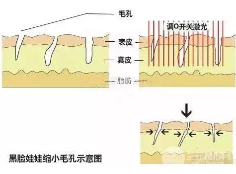 黑脸娃娃收缩毛孔示意图
