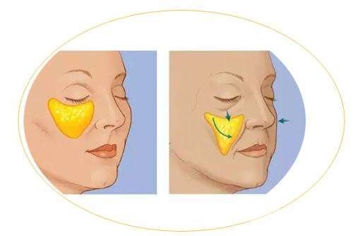 玻尿酸填泪沟会有依赖性吗?术后护理需谨记~