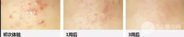 换肤手术有什么危害 get这几点就能避免！