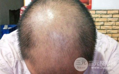 毛发移植术后应该注意哪些问题