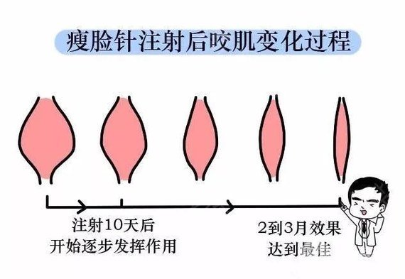 注射瘦脸原理