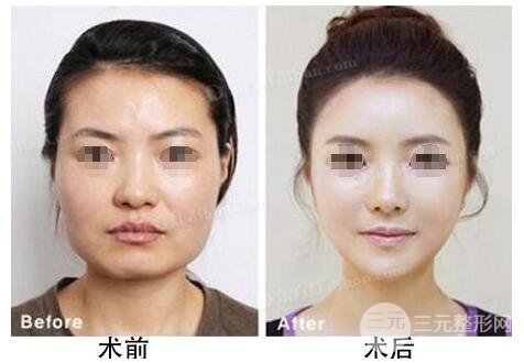 脸部吸脂手术果