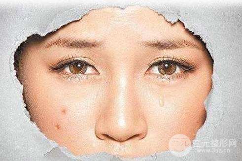 激光去黑头的果怎么样