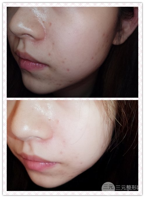 激光去黑头的果图前后对比