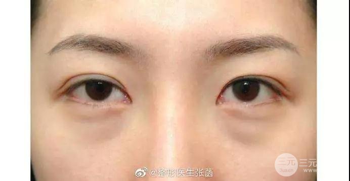 眼袋
